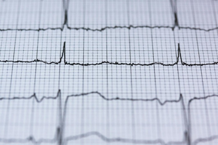 Papier do EKG – Niezawodne materiały dla dokładnych wyników badań